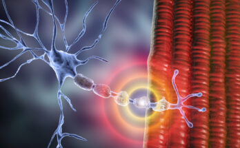 Demyelination of neuron, the damage of the neuron myelin sheath seen in demyelinating diseases, 3D illustration. Multiple sclerosis and other demyelinating myelinoclastic and leukodystrophic diseases