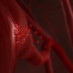 Haemorrhage, illustration