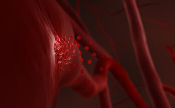 Haemorrhage, illustration