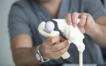 surgeon shows plastic hip to patient