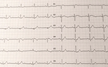 Abb. 1: Erst-EKG. Normofrequenter Sinusrhythmus, HF ~ 60/min, Normaltyp, normale Zeiten. Angedeutete ST-Senkung in I, T‑Negativierung in aVL, hyperakut imponierende T‑Wellen in II, III und aVF und pathologische Q‑Zacken-Bildung in V2–V4. In Zusammenschau mit der Klinik vereinbar mit einem akuten Herzinfarkt, der von einer sofortigen perkutanen Koronarintervention (PCI) profitieren würde