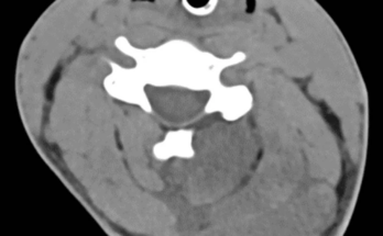 Abb. 2: CT-Untersuchung des Halses mit stark ödematöser Nackenmuskulatur auf der linken Seite. (© Autoren)
