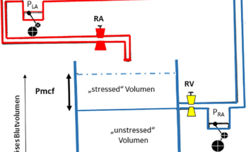 Badewannenmodell von Magder und Varennes. Das venöse System ist als Badewanne mit einem höherliegenden Abfluss und einem beweglichen Badewannenboden dargestellt. Die hydrostatische Druckdifferenz zwischen Flüssigkeitsoberfläche und der Höhe des Abflusses (Rechter Vorhofdruck; PRA) bestimmt das aktuelle zirkulierende Blutvolumen („stressed Volumen“). Das unter dem Abfluss liegende Flüssigkeitsvolumen („unstressed Volumen“) kann bei Bedarf durch Anheben des Badewannenbodens (= Abnahme der venösen Compliance) mobilisiert werden. Pmcf mittlerer systemischer Füllungsdruck, SNS sympathisches Nervensystem, RV venöser Widerstand, RA arteriolärer Widerstand, PRA rechter Vorhofdruck, PLA linker Vorhofdruck